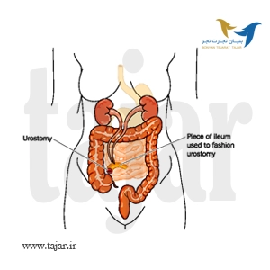 UROSTOMY surgery