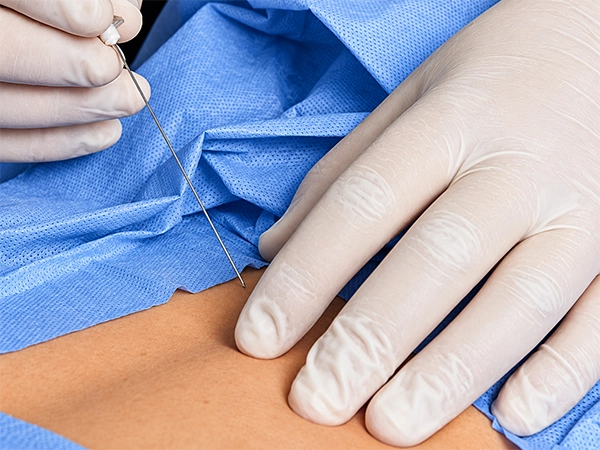 Using a spinal needle