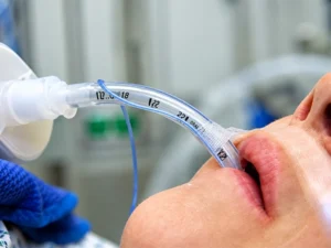 History of the Endotracheal Tube: From Discovery to Development