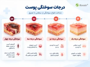 نمایش انواع درجه سوختگی 