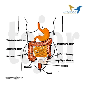 جراحی COLOSTOMY