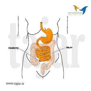 جراحی Ileostomy